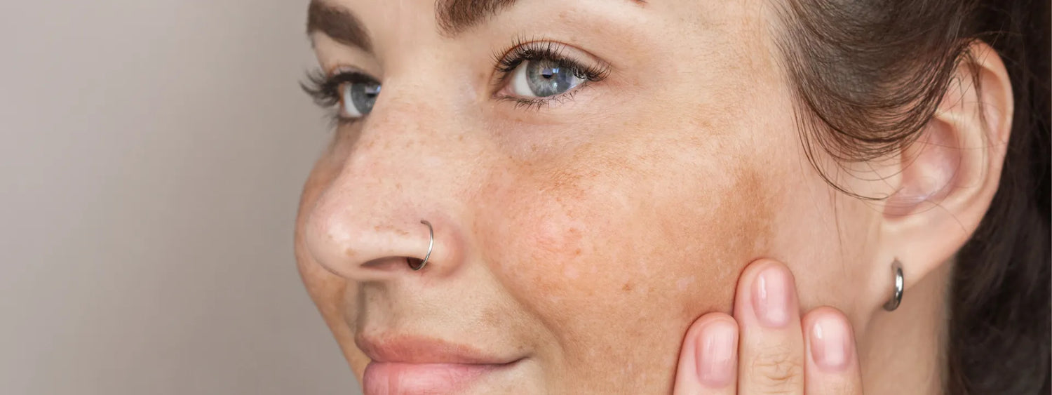 Υπερμελάγχρωση: Κατανόηση και Αντιμετώπιση των Σκούρων Κηλίδων για Λαμπερό και Ομοιόμορφο Χρώμα Δέρματος